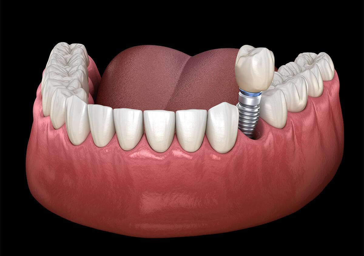 Benefits of Dental Implants in Encinitas CA Area