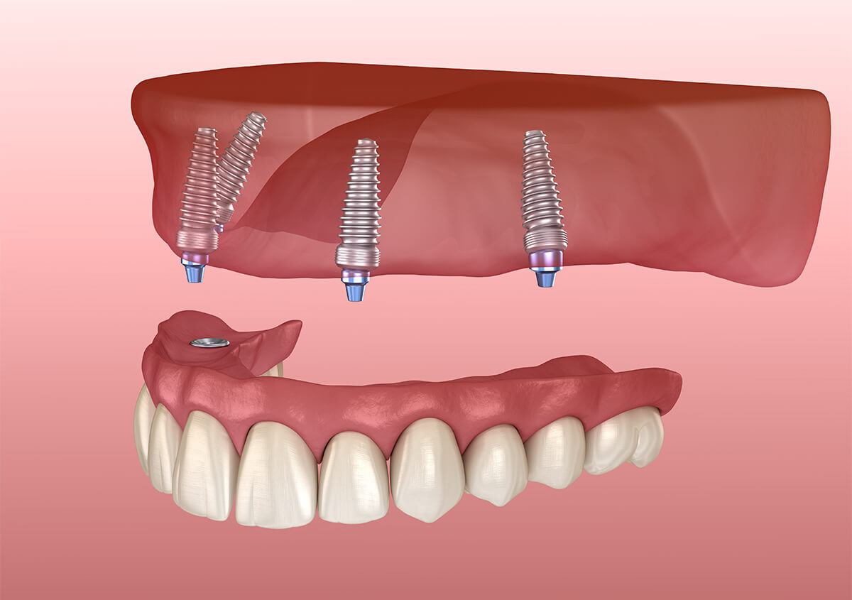 Implant Supported Dentures in Encinitas CA Area