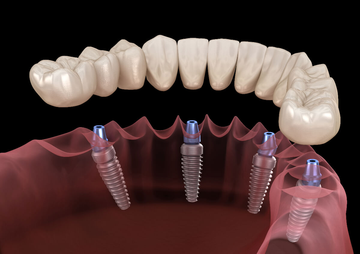 Implant Supported Dentures in Encinitas CA area